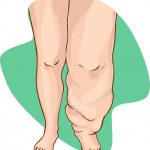 Lymphedema of the disease