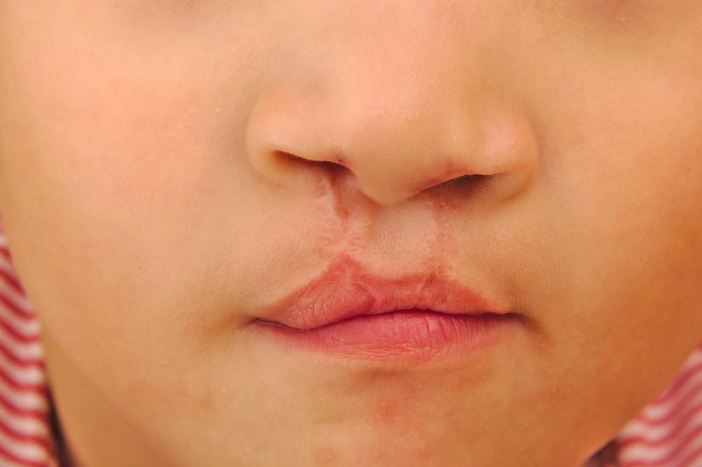 Boy showing a bilateral cleft lip repaired