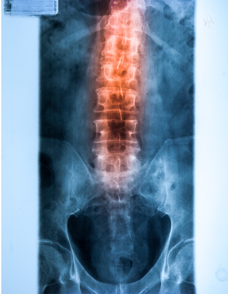 X ray MRI - Image of Spinal Column Neck pain